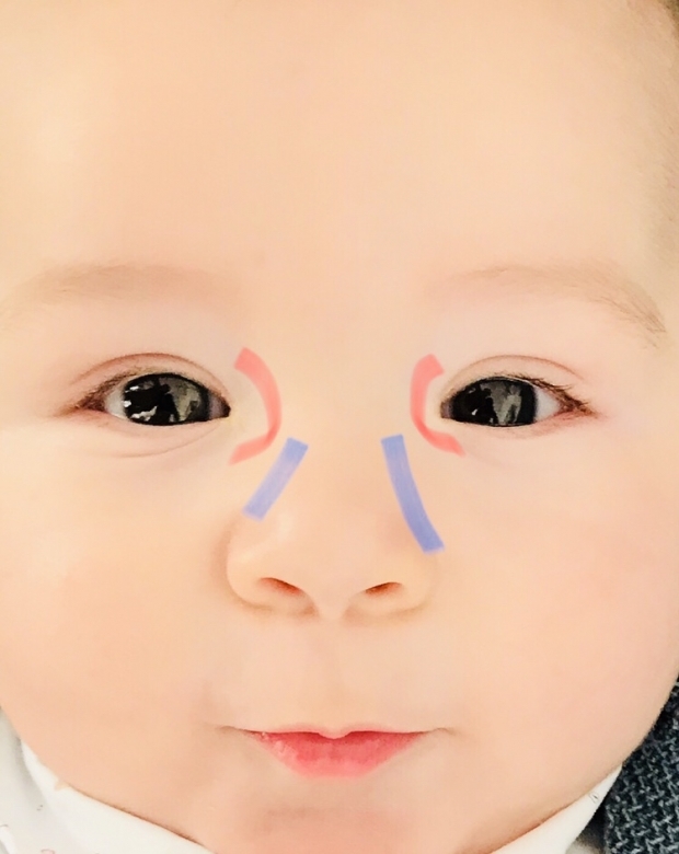 शिशुओं में आँख की गड़गड़ाहट की मालिश