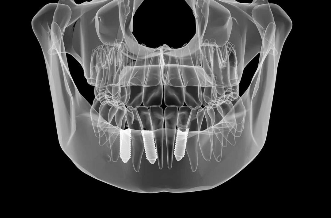 दंत प्रत्यारोपण उपचार से पहले और बाद में क्या किया जाता है?