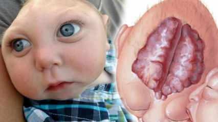 अनसेफली क्या है? शिशुओं और बच्चों में एनानेसफली के लक्षण क्या हैं? एंसेफली कारण ...