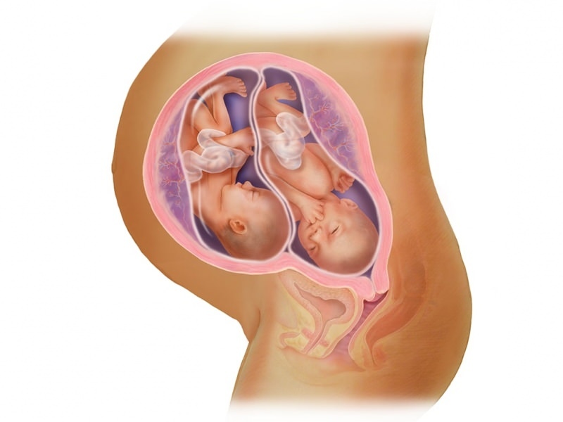 आईवीएफ में जुड़वां गर्भावस्था! भ्रूण स्थानांतरण क्या है?