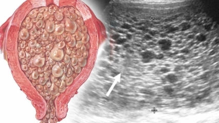 मोल प्रेग्नेंसी (अंगूर गर्भावस्था), लक्षण क्या हैं? तिल गर्भावस्था को कैसे समझें?