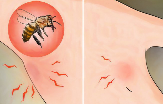 मधुमक्खी एलर्जी क्या है और इसके लक्षण क्या हैं? प्राकृतिक तरीके जो मधुमक्खी के डंक के लिए अच्छे हैं