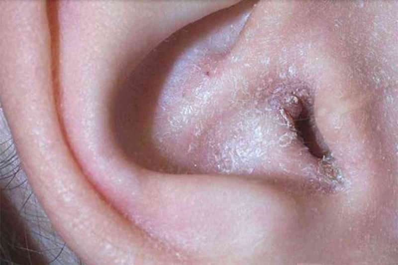 कान के पीछे छीलने का क्या कारण है और यह कैसे गुजरता है? कान के पीछे एक्जिमा के लिए निश्चित समाधान ...
