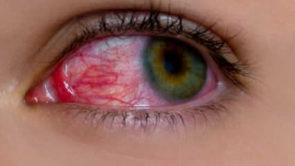 आंखों की एलर्जी किन कारणों से होती है? आंखों की एलर्जी के लक्षण क्या हैं? आंखों की एलर्जी के लिए क्या अच्छा है? 