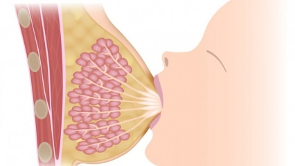 मास्टिटिस (स्तन की सूजन) क्या है? स्तनपान के दौरान मास्टिटिस के लक्षण और उपचार