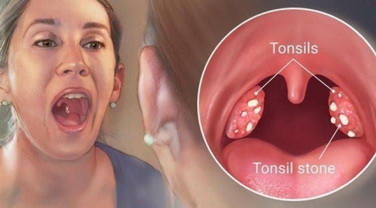 टॉन्सिलिटिस को टॉन्सिल की सूजन कहा जाता है