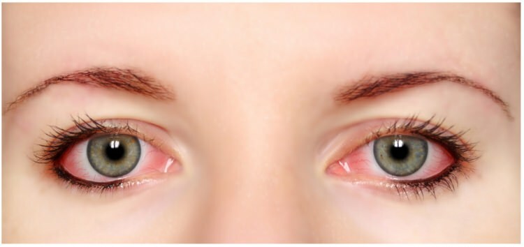 आंखों में काजल और आईलाइनर एलर्जी करता है?