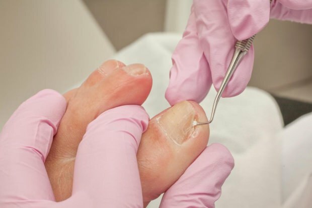 क्या toenails का कारण बनता है और लक्षण क्या हैं? प्राकृतिक तरीके जो नाखूनों के लिए अच्छे होते हैं ...