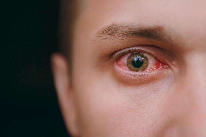 आंखों में पानी आना, रक्तस्राव और खुजली कोरोनावायरस लक्षण