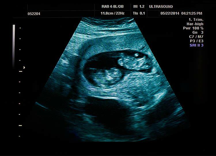 जुड़वां गर्भावस्था में जन्म को प्रभावित करने वाले कारक