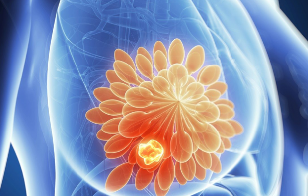 स्तन कैंसर कैसे होता है? स्तन कैंसर के लक्षण क्या हैं और क्या उनका इलाज है?
