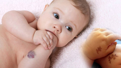 शिशुओं में जन्म का कारण, क्या यह स्थायी है? जन्म के प्रकार क्या हैं? साराकोग्लू से इलाज