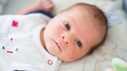 बच्चे के चेहरे पर पिंपल्स कैसे गुजरते हैं? मुँहासे (मिलिया) सुखाने के तरीके