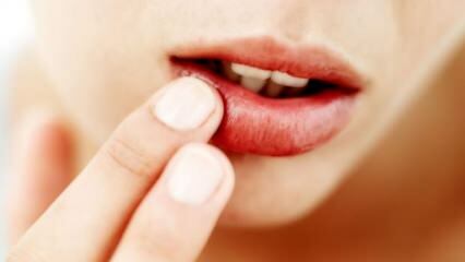 होंठ फटने के लिए क्या अच्छा है?