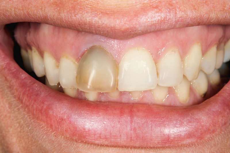 दांतों को काला करना कभी-कभी एक दांत पर ध्यान केंद्रित कर सकता है