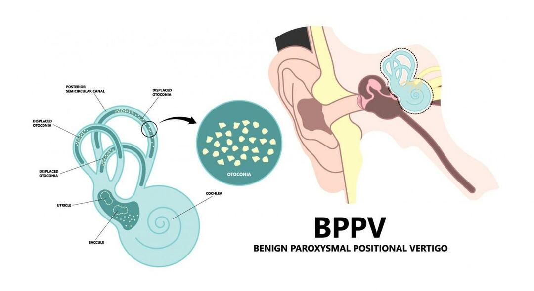 लेटते समय सिर क्यों घूमता है? सौम्य पैरॉक्सिस्मल पोजिशनल वर्टिगो के लिए क्या अच्छा है? बीपीपीवी से कैसे छुटकारा पाएं