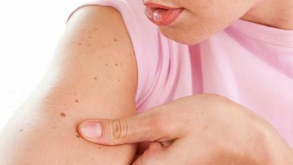 त्वचा (त्वचा) कैंसर क्या है और इसके लक्षण क्या हैं? त्वचा कैंसर को समझने के तरीके