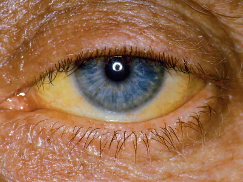 बिलीरुबिन स्तर पर ऊंचाई आंखों और त्वचा पर पीले रंग का कारण बनती है