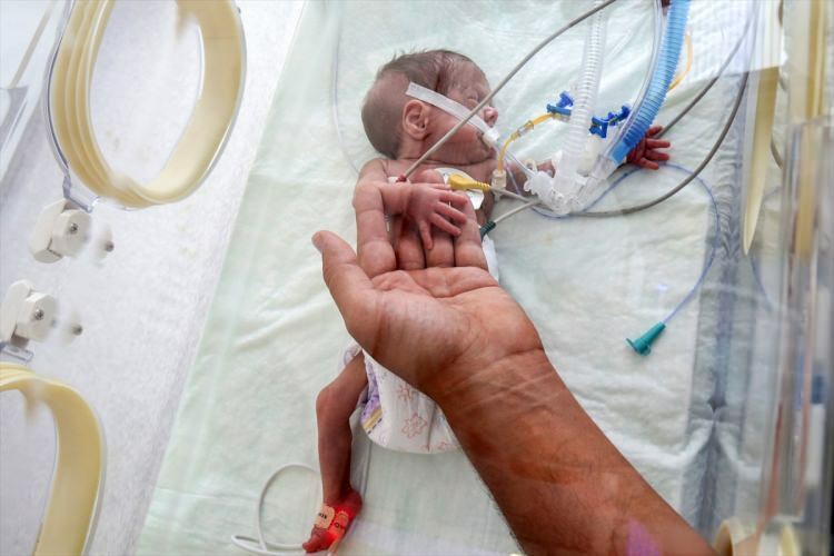 'मिरेकल बेबी' सर्जरी से बच गया