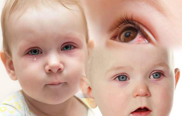 शिशुओं की आँखों से खून क्यों निकलता है? नवजात शिशु में नेत्र रक्तस्राव कैसे गुजरता है?
