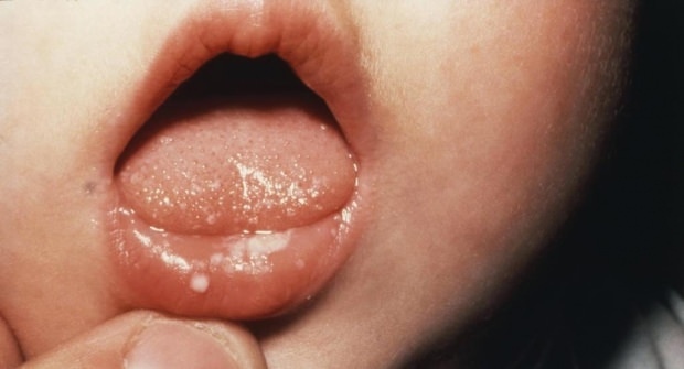शिशुओं में मुंह के छाले कैसे होते हैं