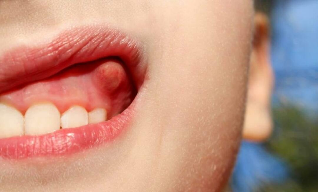 दांत में फोड़ा क्यों होता है और लक्षण क्या हैं? दाँत का फोड़ा, इसका इलाज कैसे किया जाता है?
