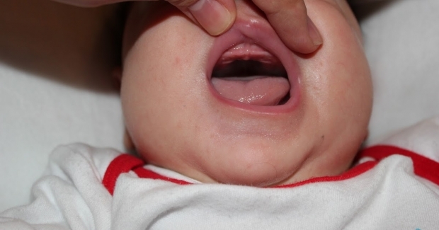 शिशुओं में तालु की गिरावट क्या है, क्यों? लक्षण और उपचार ...