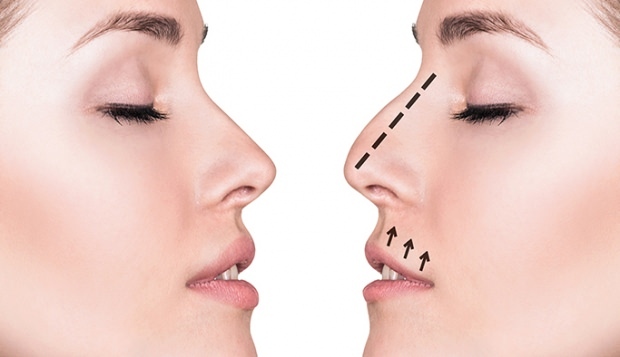 नाक की सर्जरी कैसे की जाती है? राइनोप्लास्टी सर्जरी किन मामलों में की जाती है?
