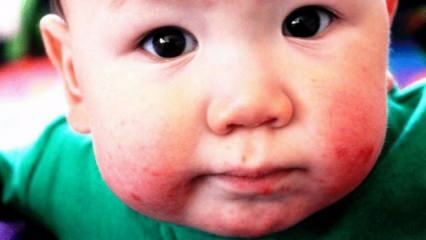 शिशुओं में मुंह के छाले कैसे होते हैं? बचपन और बच्चों में मौखिक घावों के लिए क्या अच्छा है?