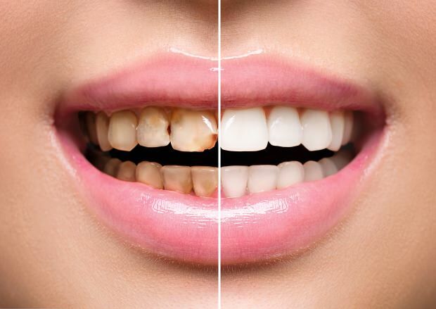 अस्वास्थ्यकर पोषण के परिणामस्वरूप, दाँत की मलिनकिरण और दाँत की हानि दोनों होती हैं