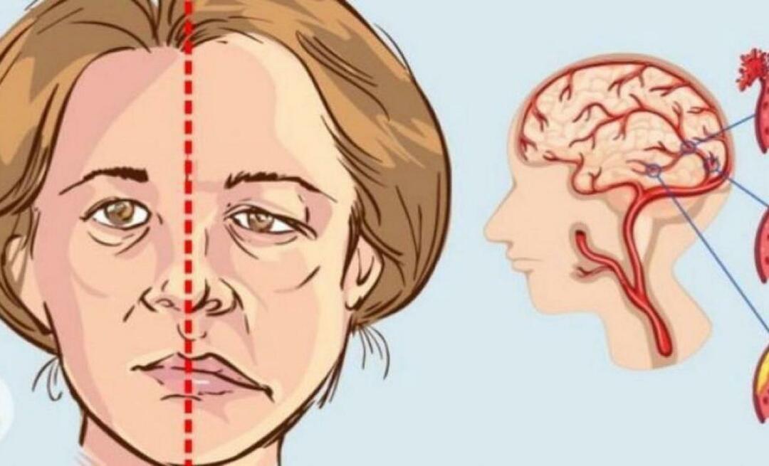 आघात क्या है? स्ट्रोक के लक्षण क्या हैं? स्ट्रोक को कैसे रोकें?