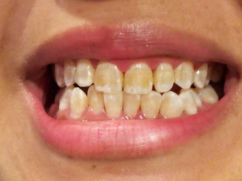 जिस व्यक्ति के दांत काले पड़ने लगते हैं, उसके दांत की छवि