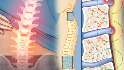 रीढ़ की हड्डी संकीर्ण क्या है? रीढ़ की हड्डी के संकुचित होने के लक्षण क्या हैं? क्या रीढ़ की हड्डी के संकीर्ण होने का कोई इलाज है?