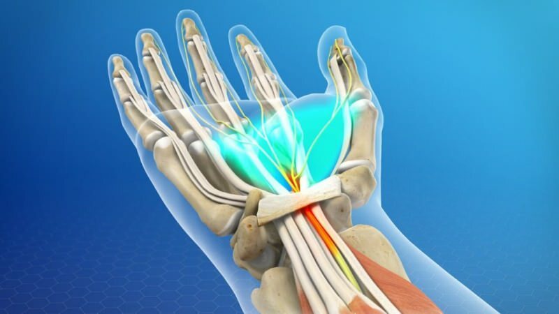 दबाव के परिणामस्वरूप, कलाई की मांसपेशियों की प्रणाली क्षतिग्रस्त हो जाती है, जो कार्पल टनल सिंड्रोम का कारण बनती है