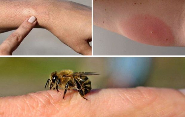 मधुमक्खी एलर्जी के लक्षण