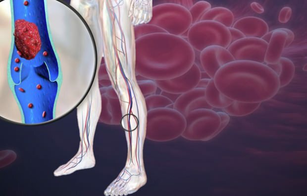पैर की नसों में रक्त संचार कम होने से दर्द होता है